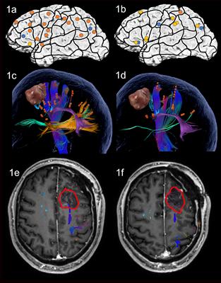 Dual-Task nTMS Mapping to Visualize the Cortico-Subcortical Language Network and Capture Postoperative Outcome—A Patient Series in Neurosurgery